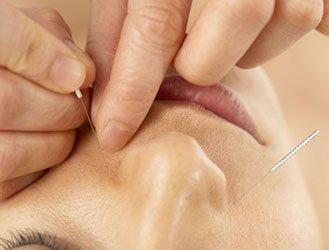 Prevent winter ailments with acupuncture