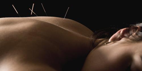 Acupuncture, well-being at the tip of the needle
