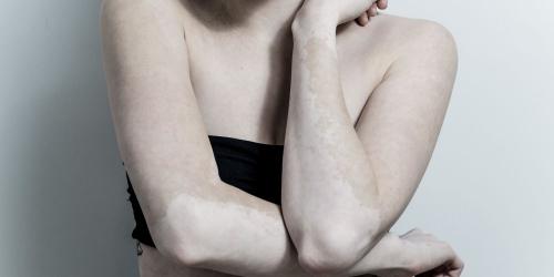 Skin diseases, a scourge still too underestimated