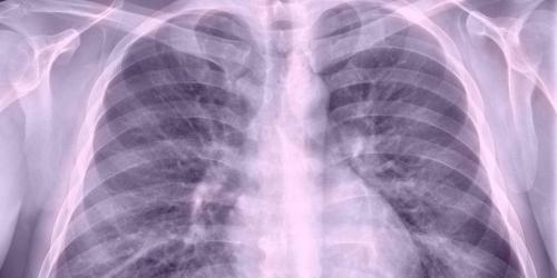 Pneumonia: 5 signs that must alert us